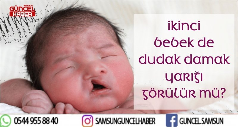 İKİNCİ BEBEK DE DUDAK DAMAK YARIĞI GÖRÜLÜR MÜ?