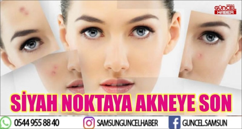 SİYAH NOKTAYA AKNEYE SON