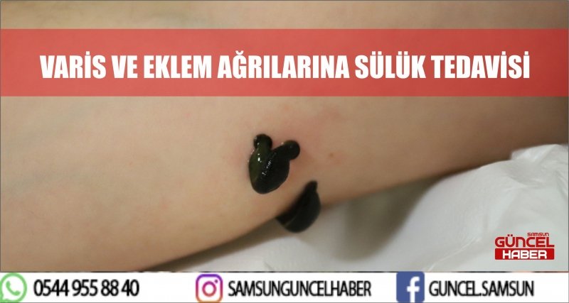 VARİS VE EKLEM AĞRILARINA SÜLÜK TEDAVİSİ