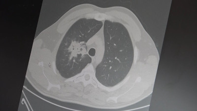 Uzmandan elektronik sigara uyarısı: “Kanser riskini artırıyor”