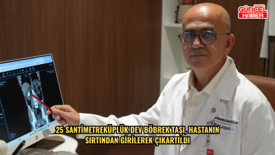 25 santimetreküplük dev böbrek taşı, hastanın sırtından girilerek çıkartıldı